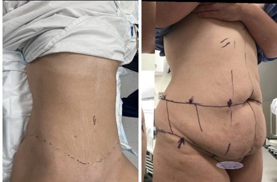 Circumferential abdominoplasty before and after results — Dr Oliver Florica FRACS Sydney