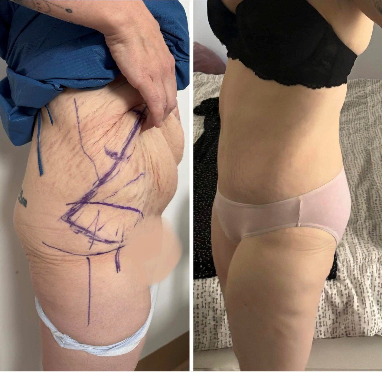 Circumferential abdominoplasty before and after — flank and abdominal contouring, Dr Oliver Florica FRACS Sydney