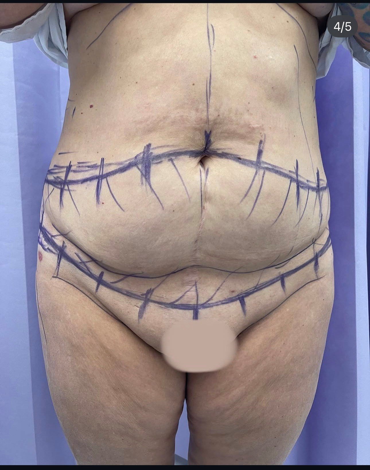 Circumferential abdominoplasty pre-op frontal markings