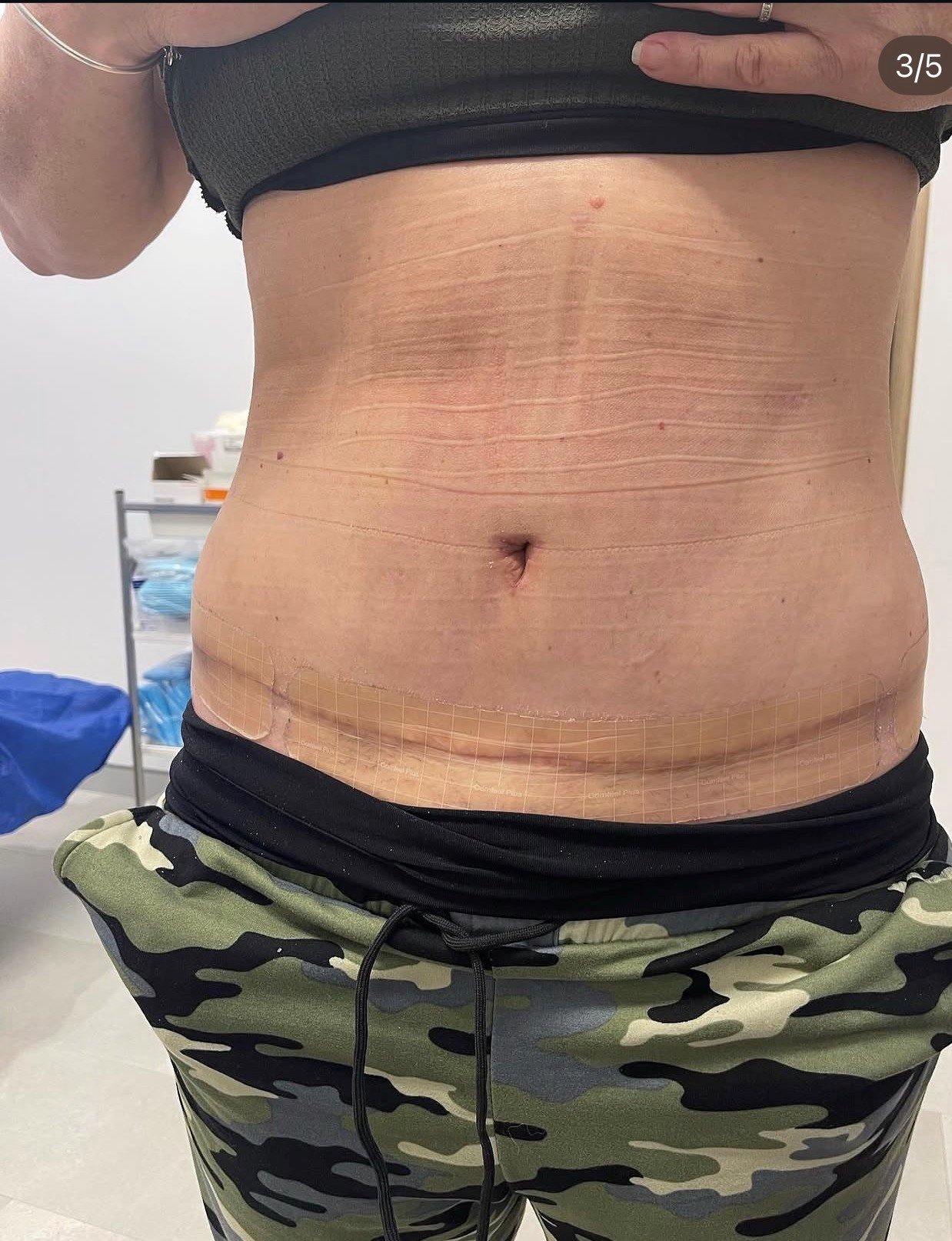 Circumferential abdominoplasty post-op frontal result