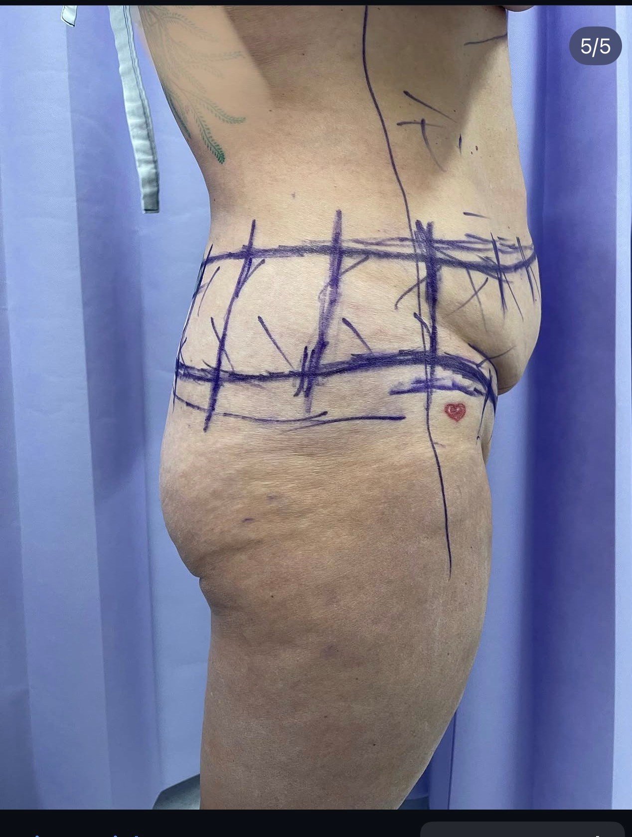 Circumferential abdominoplasty pre-op lateral markings