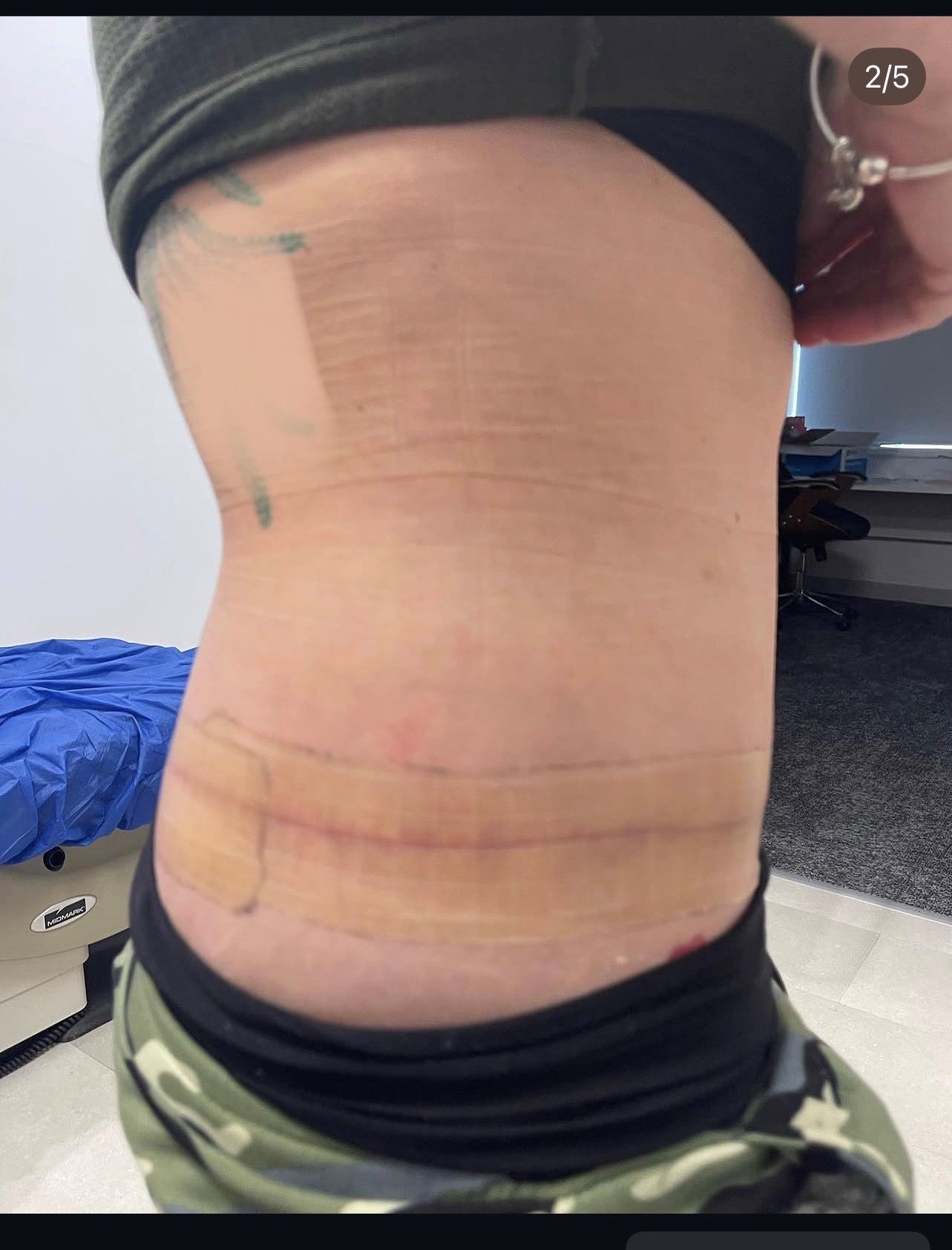 Circumferential abdominoplasty post-op lateral result