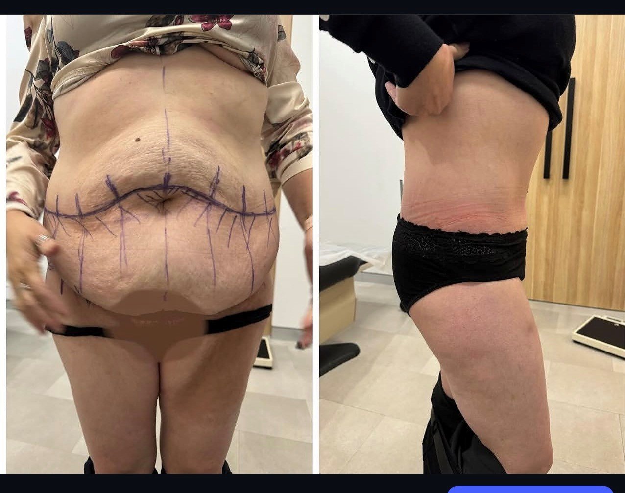 Circumferential abdominoplasty before and after — Dr Oliver Florica FRACS Sydney