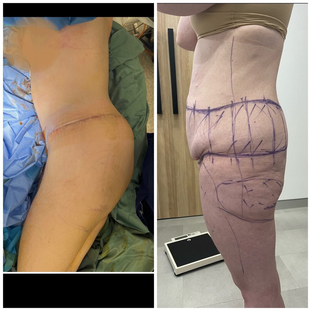 Before and after circumferential abdominoplasty (lower body lift) — side view