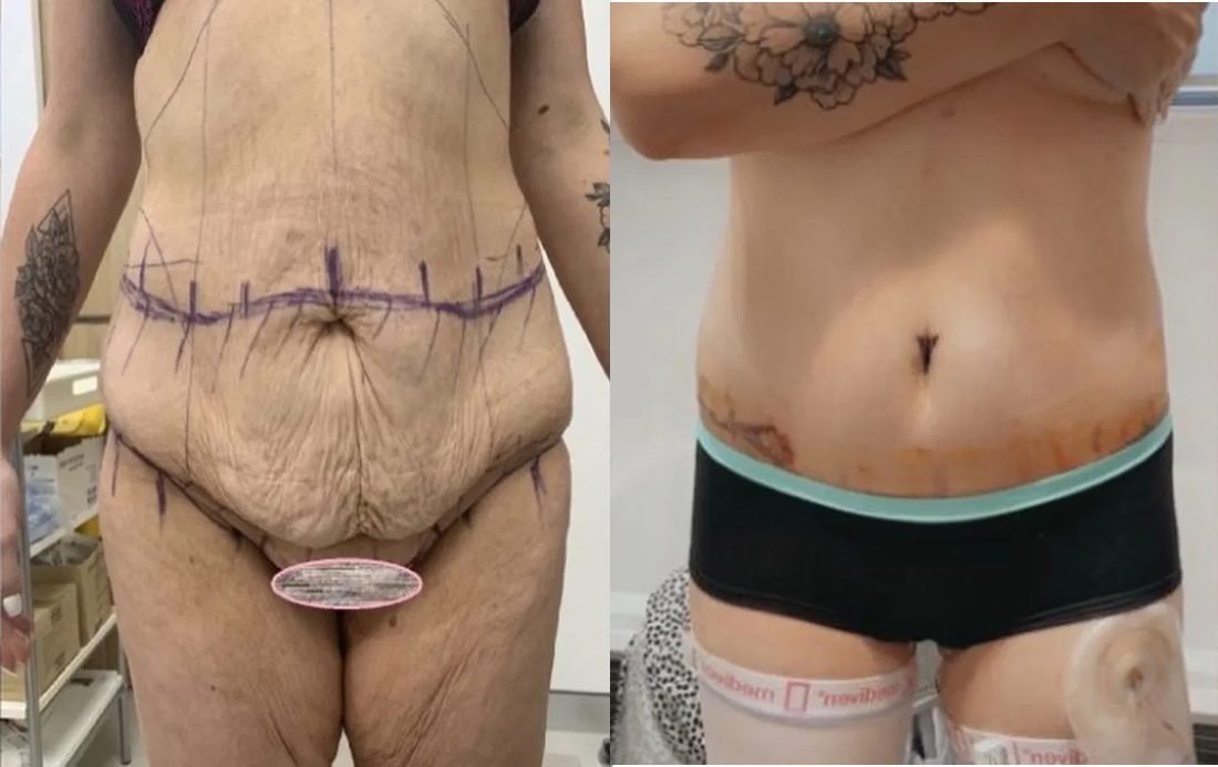 Before and after belt lipectomy — front view